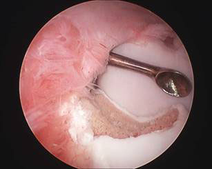 arthro2