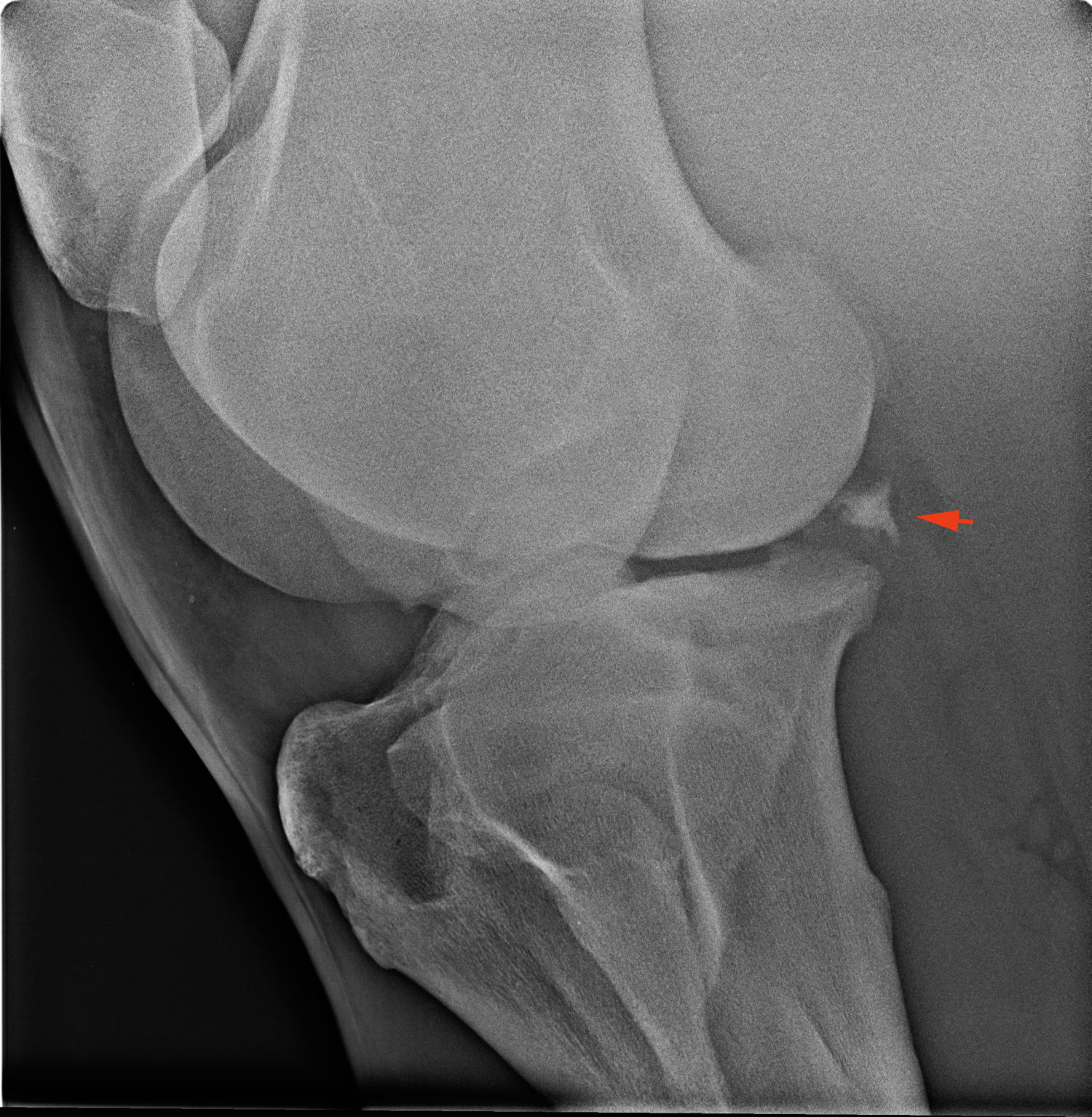 meszes meniscus